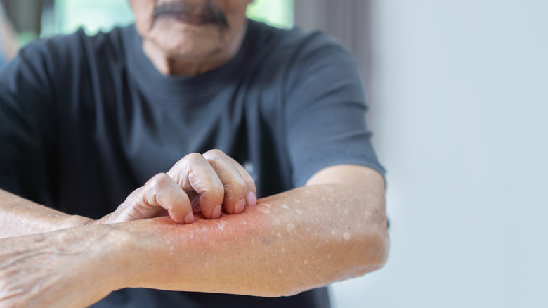 man scratching itcy arm