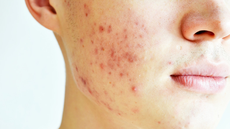 Person with acne on face
