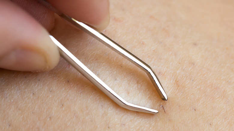 Tweezers plucking out ingrown hair