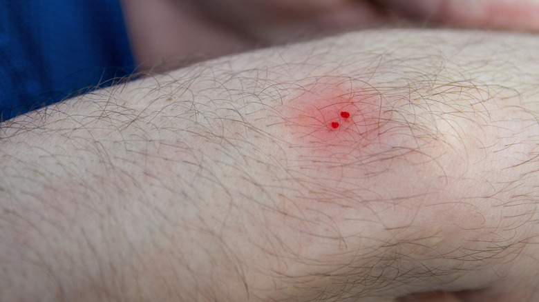 closeup of snake bite