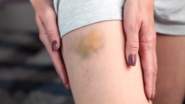 bruise on woman's leg