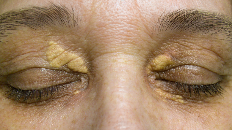 Xanthelasma bumps on skin