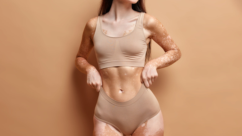 Woman with vitiligo in beige cropped top and panties 