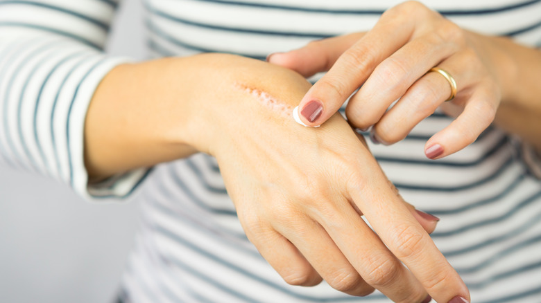 woman putting cream on scar