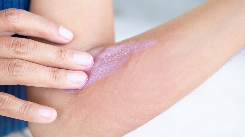 woman putting calamine lotion on arm