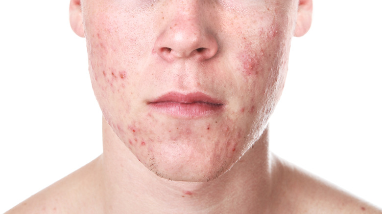 Teen boy with acne