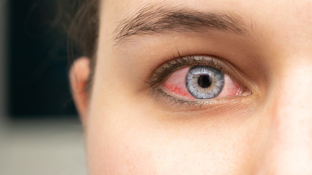 Young girl with conjunctivitis pointing to her eye