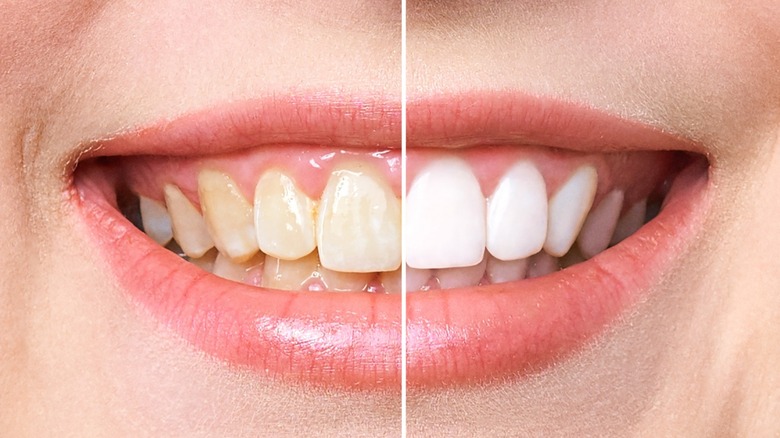 woman teeth whitening before after