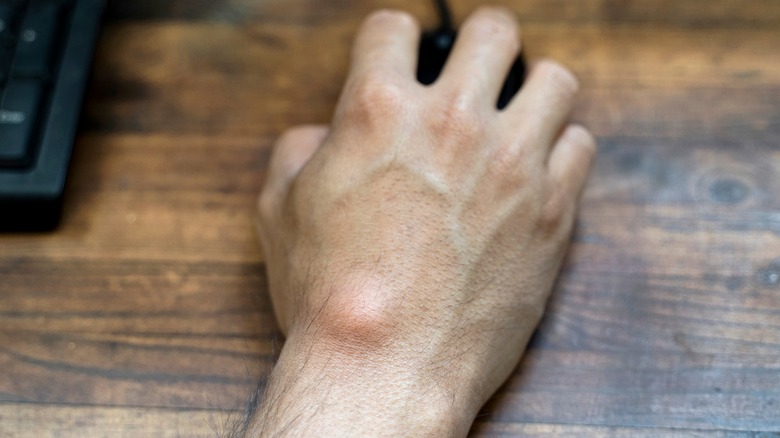 A ganglion cyst on the wrist
