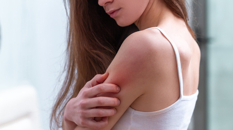 Woman scratching a poison ivy rash