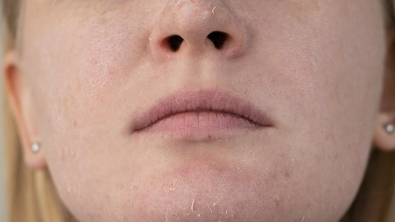 Dry flaking skin on woman's face