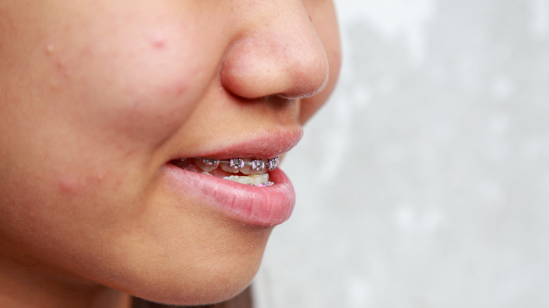 Girl with braces and an underbite