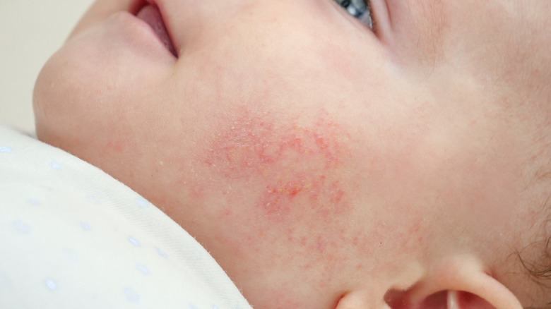 close up of a babies cheek with acne 