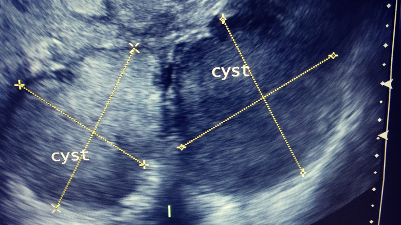 An X-ray of two cysts found on the ovaries 