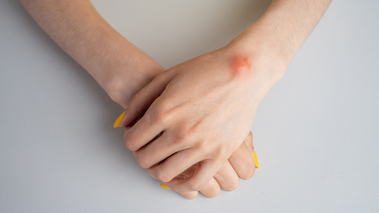 a ganglion cyst on a woman's wrist