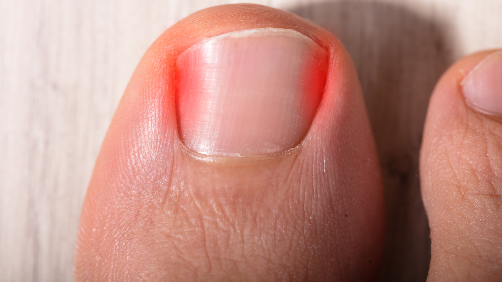 This Is What Really Causes Ingrown Nails