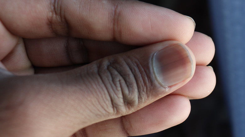 This Is What Really Causes Red And Black Spots On Fingernails