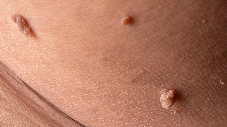 Close up of skin tags