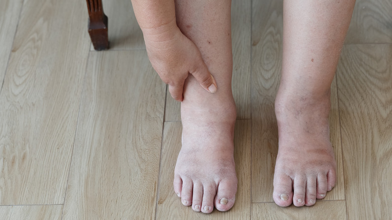 Woman with swollen ankles