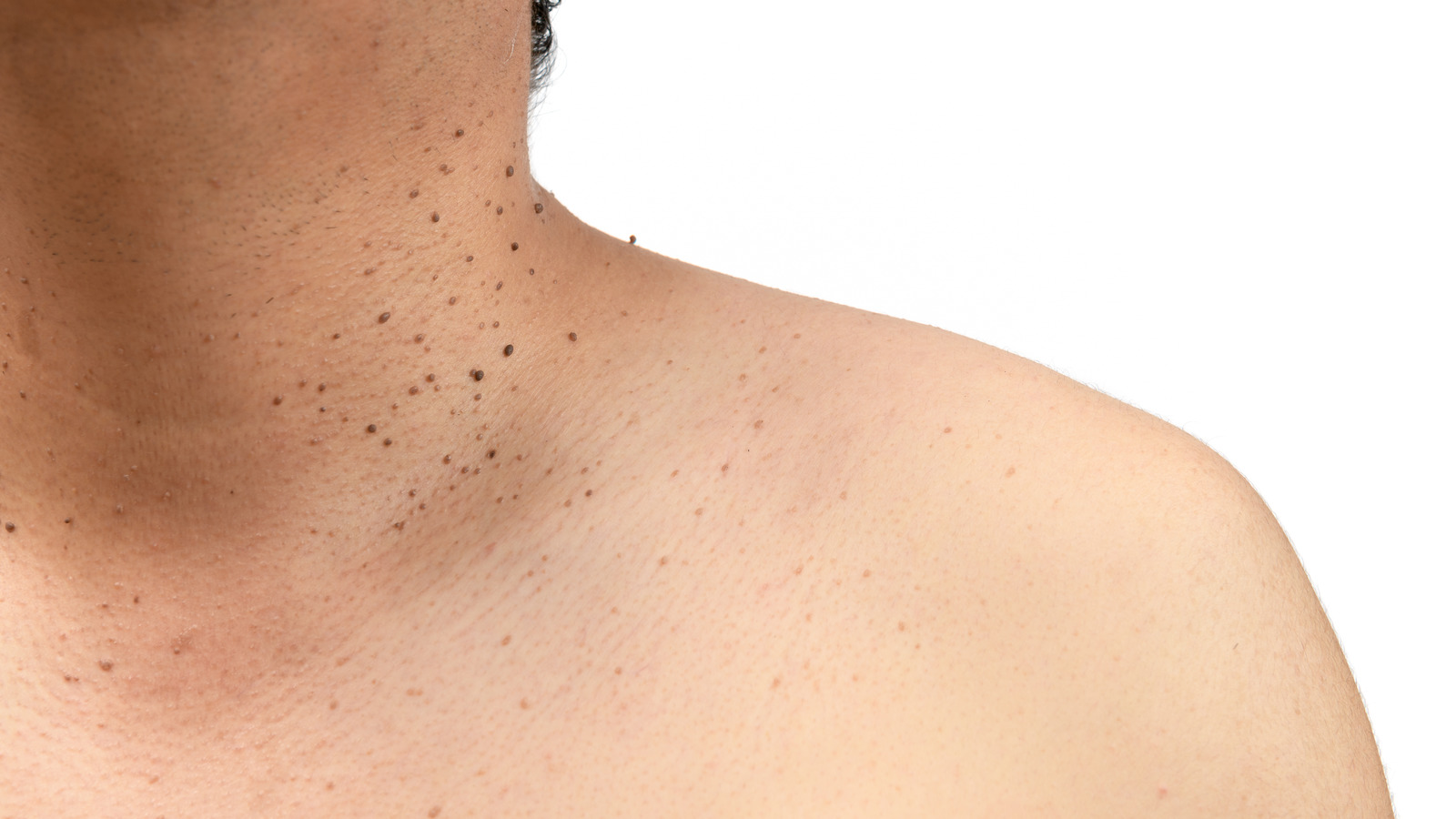 This Is What Really Happens When You Freeze Off Skin Tags