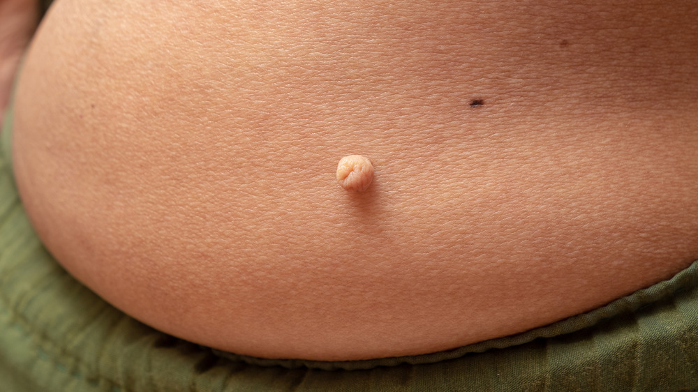 Close up of skin tag