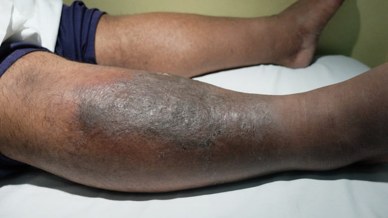 cellulitis on lower leg