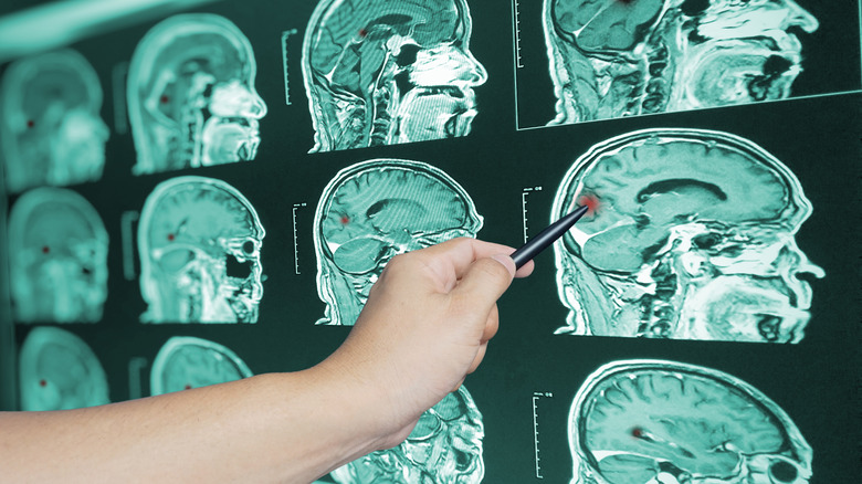A hand pointing to backlit cranial scans