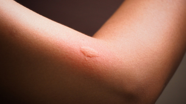 Mosquito bite on arm