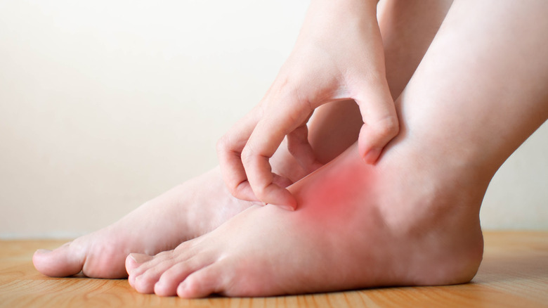 Close up of hand scratching their foot with red inflamed spot