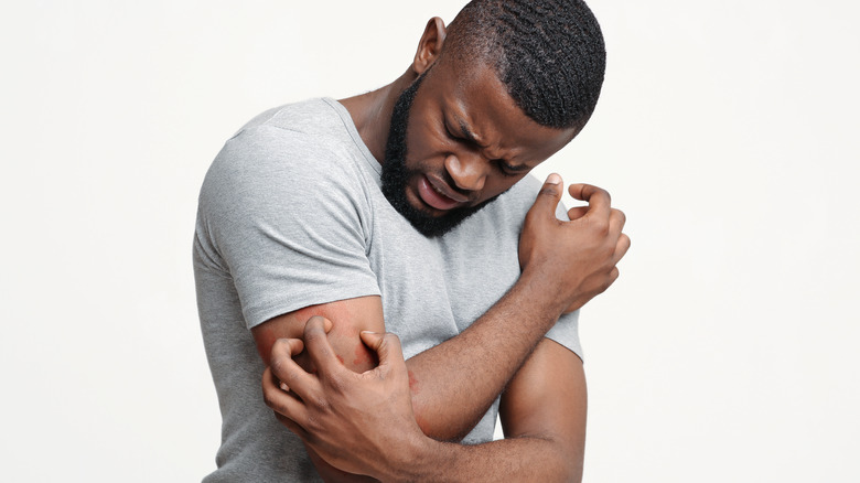 Man scratching his upper arm covered in red bites