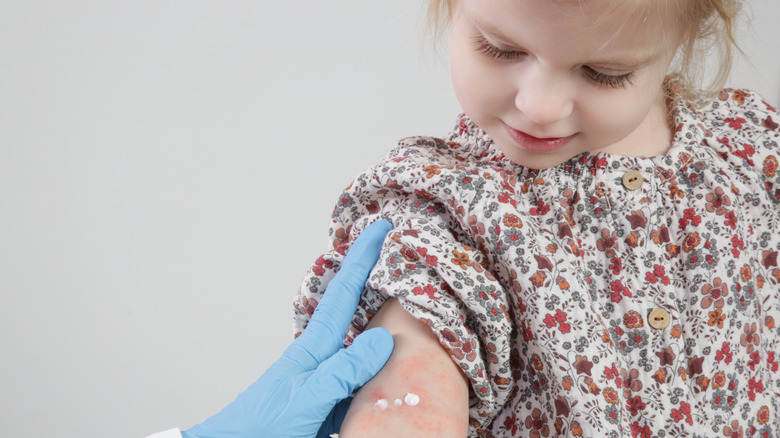 Gloved hand applying topical ointment to young child's arm covered in eczema rashes