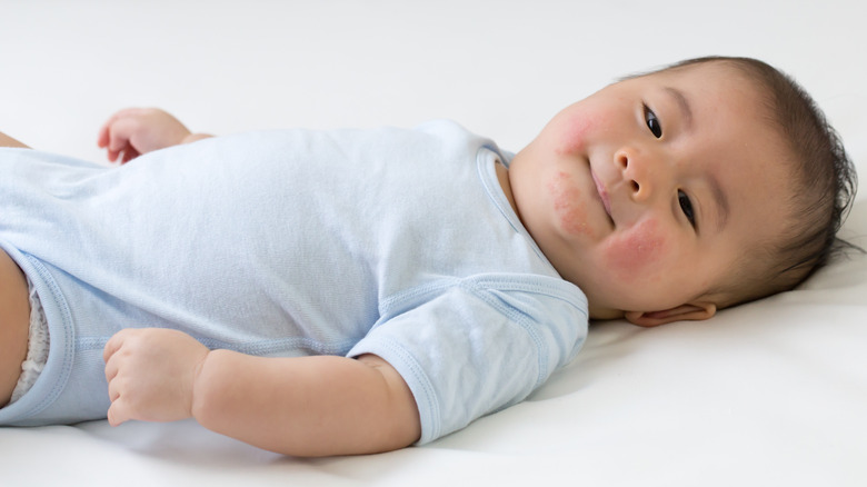 Young baby lying down with eczema on face