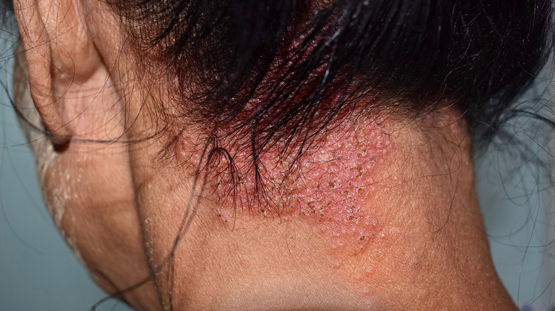 person with red, scaly patches on lower part of scalp