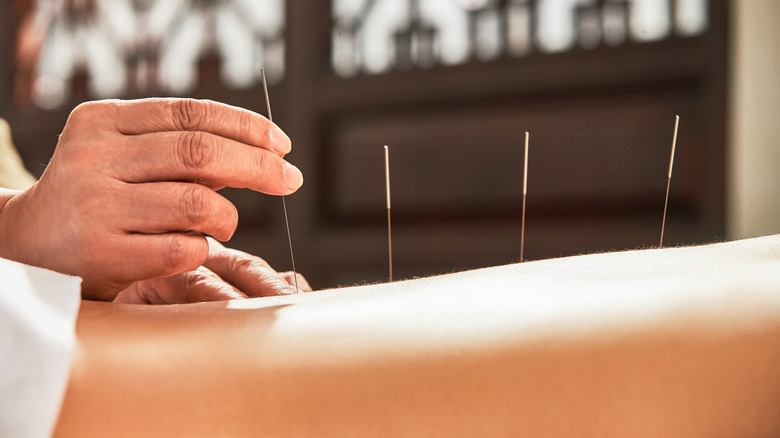 Person receiving acupuncture treatment