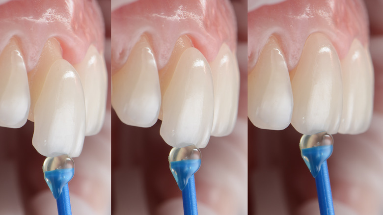 upclose veneer placement