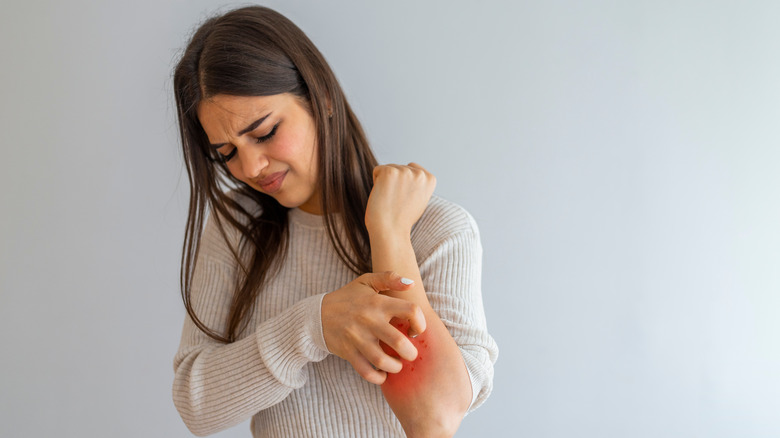 Woman scratching itchy skin on her arm