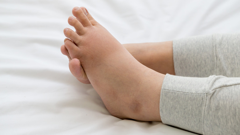 swollen feet