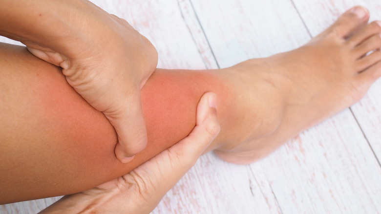 A person holding their reddened, swollen leg