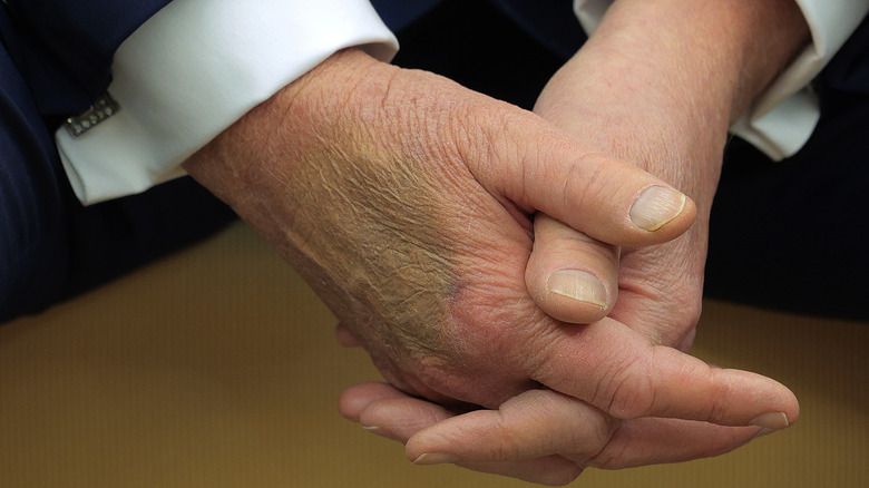 Trump's hand with bruise covered in makeup