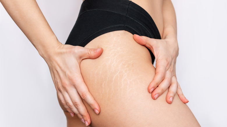woman putting her hands on her upper hips to showcase her white stretch marks