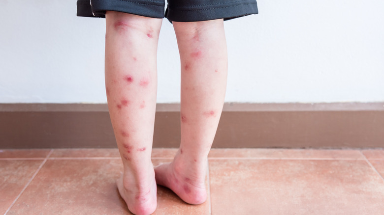 bug bites on legs