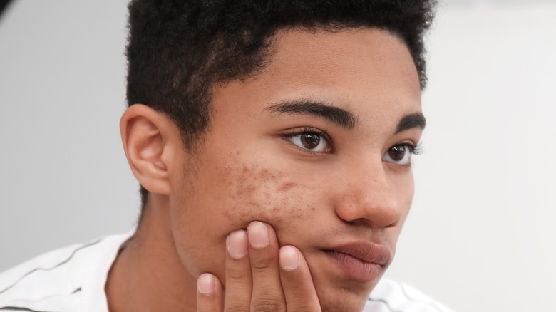 Man looking at acne in mirror