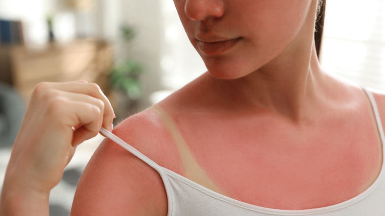Woman with sunburned shoulder