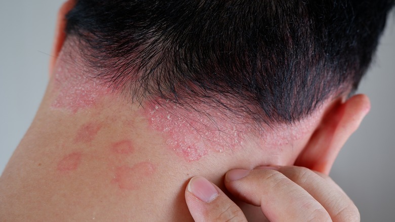 close up of psoriasis at the nape of neck