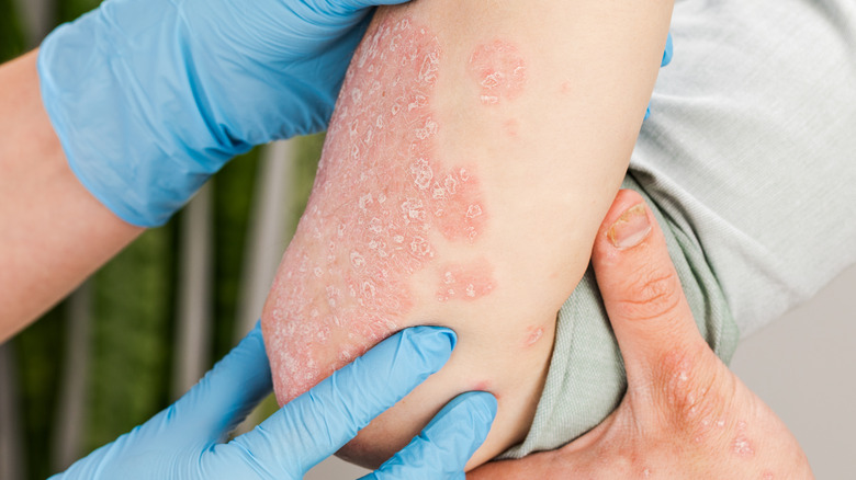 doctor examining patient's elbow with psoriasis