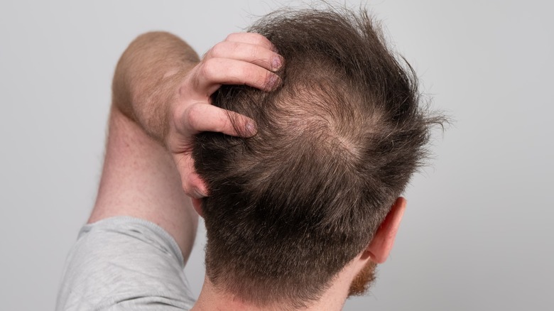 Head with scalp folliculitis