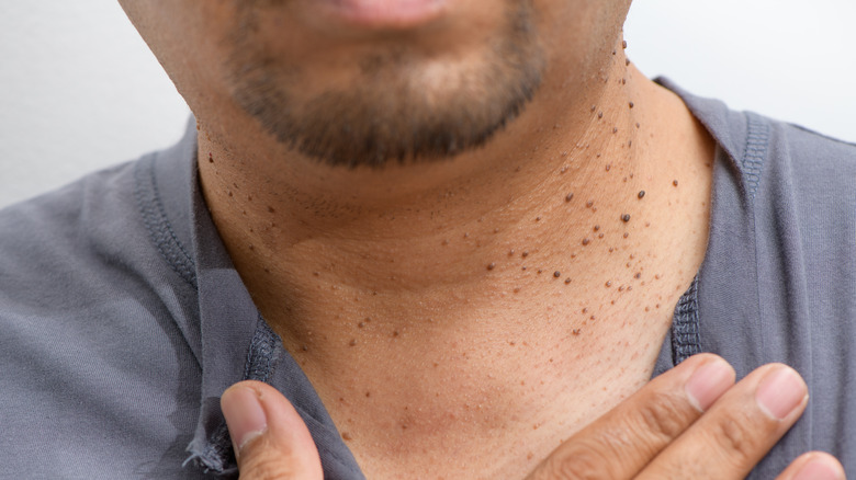 Skin tags on man's neck