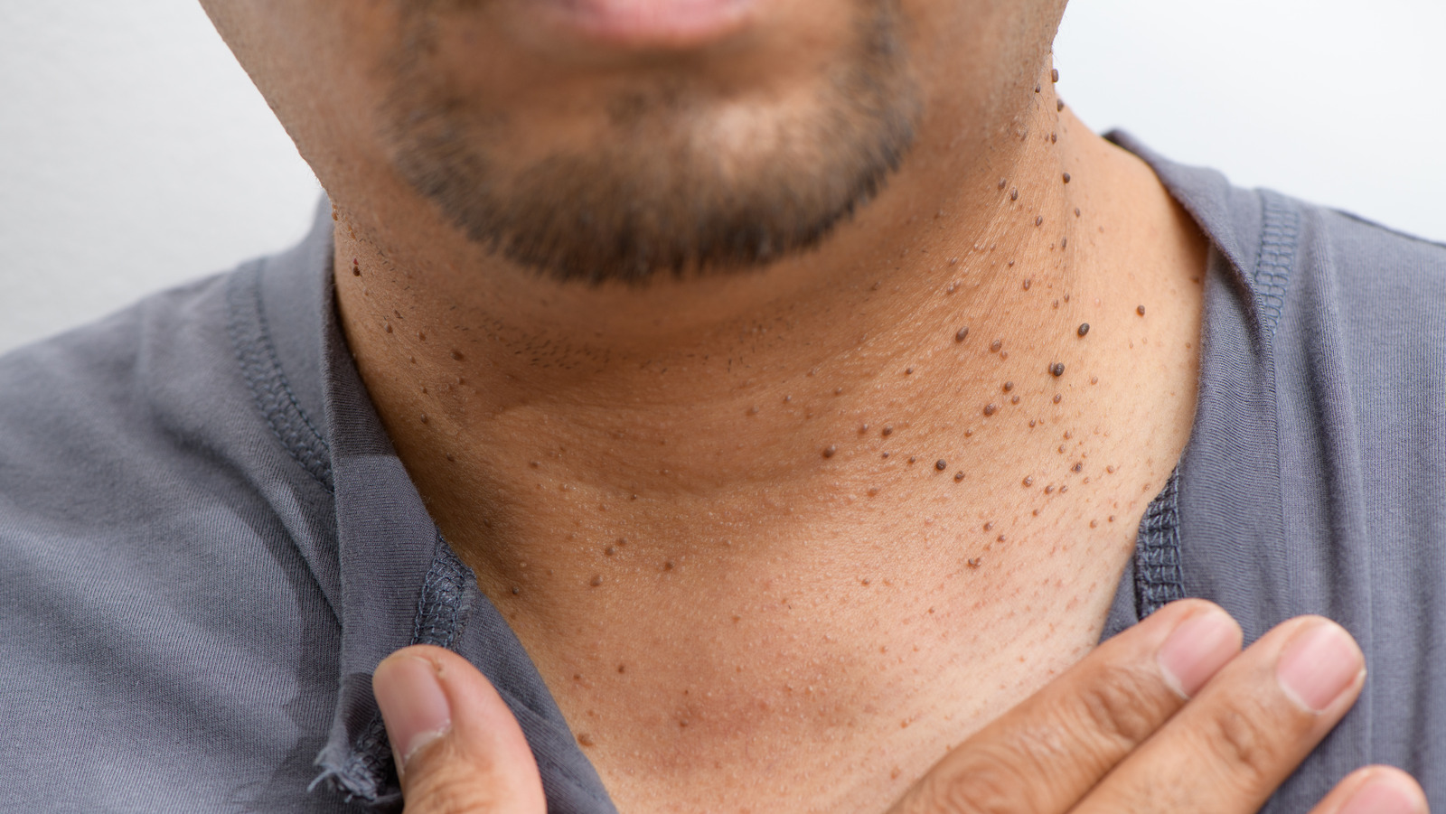 What Causes Skin Tags On Your Lips?