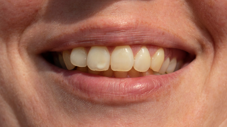 person smiling showing teeth