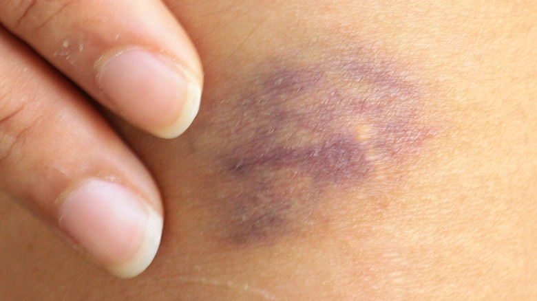 bruise on woman's leg